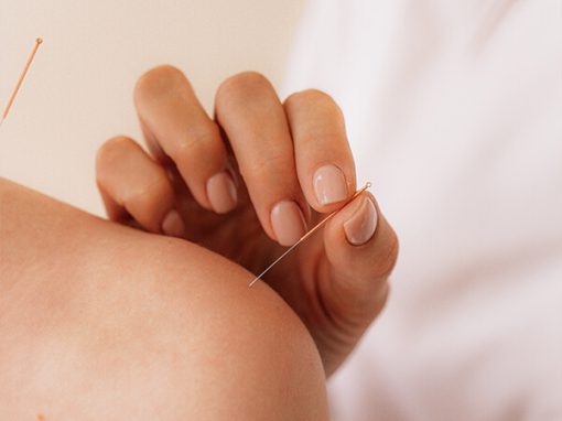Acupunctuur-510×382