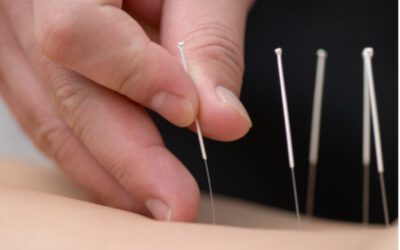 Acupunctuur bij depressie